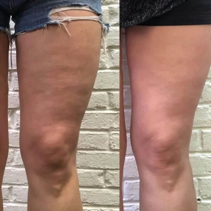 Before and after — smoother thighs