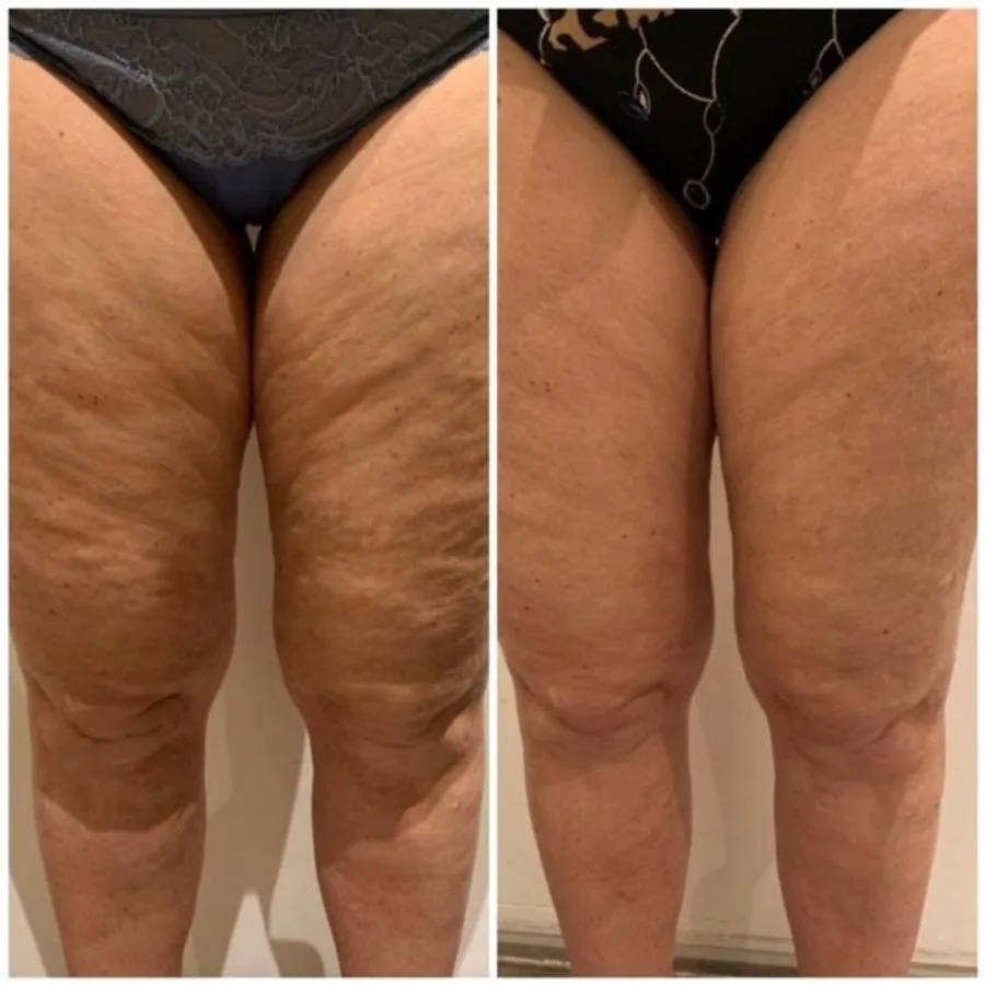 Before and after — less visible cellulite