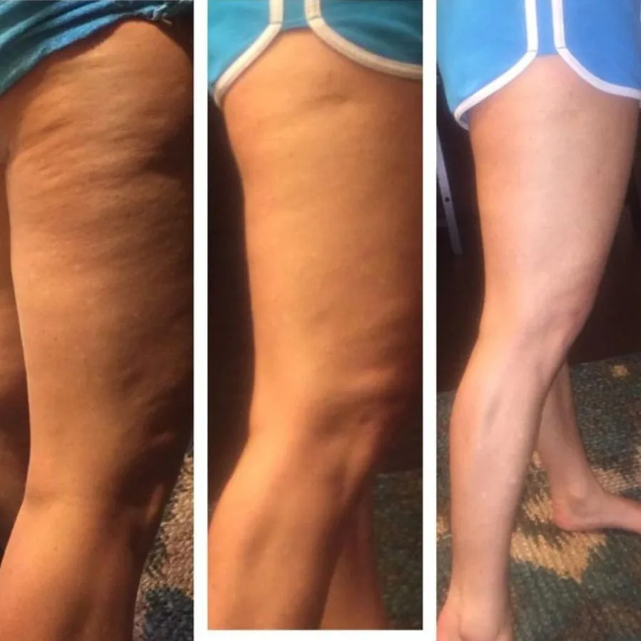 Before and after — firmer skin
