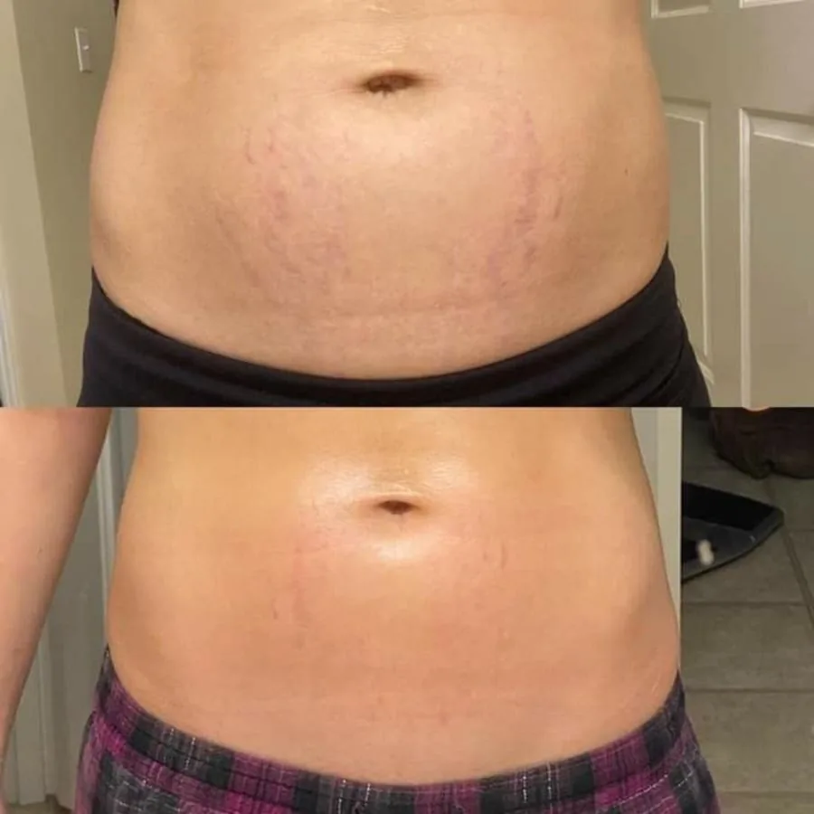 Before and after — tighter, smoother tummy