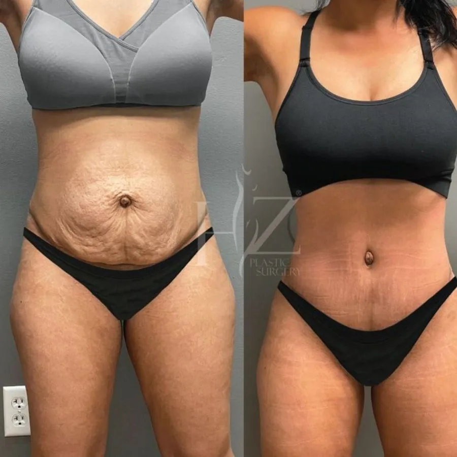 Before and after — smoother, toned skin